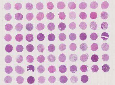 中科光华纤维来源肿瘤组织组合芯片