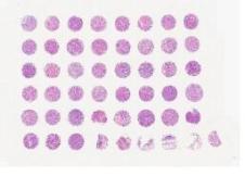 中科光华喉癌组织芯片，附WHO Grade，TNM及Stage分期