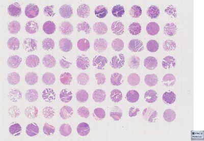 中科光华多器官肿瘤组织芯片，含Grade、TNM及Stage