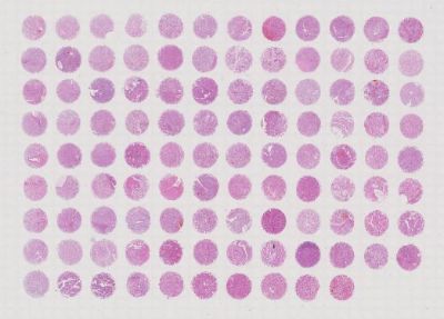 中科光华Stage I-IV期肾透明细胞癌为主芯片，含Grade 、TNM及Stage