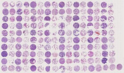 中科光华生存期肺腺癌组织芯片，提供生存期，WHO Grade，TNM和Stage分期等临床信息