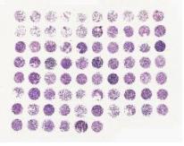 中科光华肺腺癌StageI-IV期及正常组织组合芯片，，含TNM、Stage及Grade