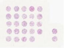 中科光华肾透明细胞癌组织测试芯片