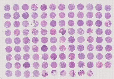 中科光华口腔鳞状细胞癌Stage I-IV期组织芯片，含Grade、TNM及Stage