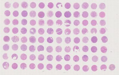 中科光华早期肝癌组织芯片，含Grade、TNM及Stage