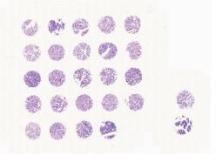 中科光华膀胱尿路上皮癌组织芯片，附WHO Grade，TNM以及Stage分期