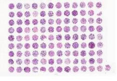 中科光华肝内胆管细胞癌组织芯片，附WHO Grade, TNM及Stage分期（AJCC8#）