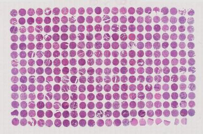 中科光华宫颈鳞癌组织芯片，含Grade、TNM及Stage