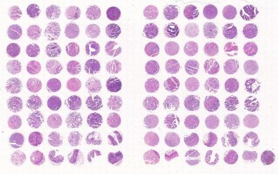 中科光华消化系统化疗后肿瘤及未化疗肿瘤及其匹配的瘤旁组织组合芯片